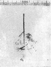 Рентгенограмма    (позитив)  сукна   по  месту  поражения с  расстояния    25   м   винтовочной  бронебойно- зажигательной   пулей,  прошедшей   через   преграду    (кончик   иглы   указывает   на   центр   входного   отверстия) Пятна    копоти,    непроницаемые  для рентгеновых  лучей;      осколки   разорвавшейся    пули