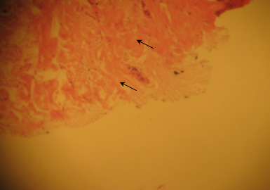 Соединительно-тканные волокна собственно дермы в виде «метелок». Горизонтальные щели в собственно дерме, сдавление сосудов собственно дермы