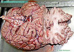 Колено мозолистого тела