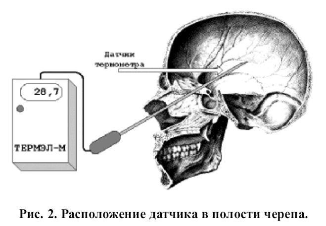 Расположение датчика в полости черепа