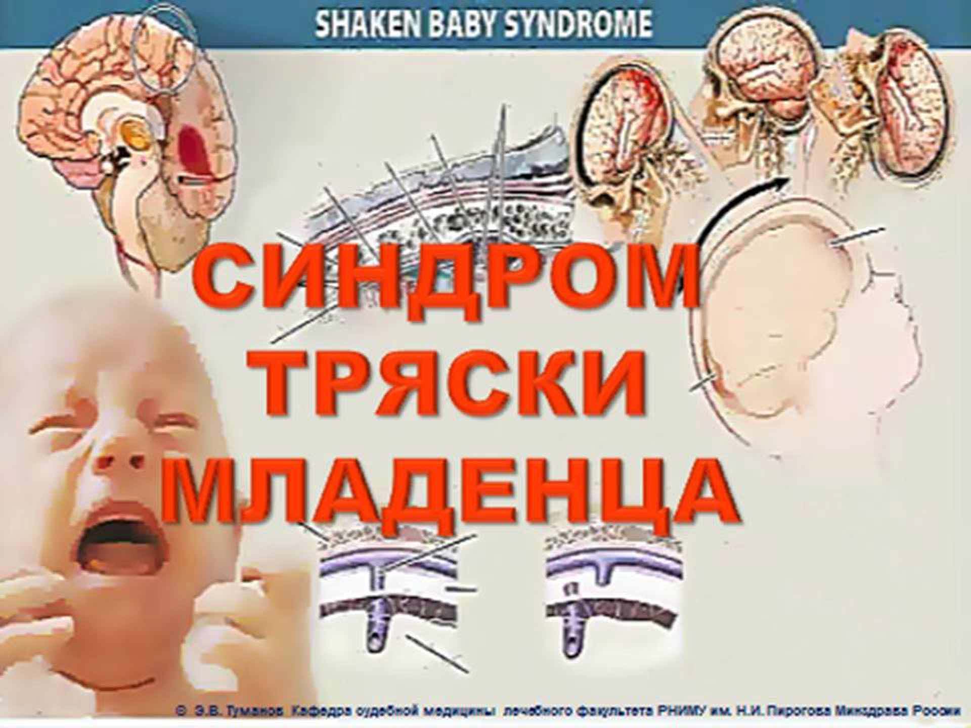Синдром тряски младенца