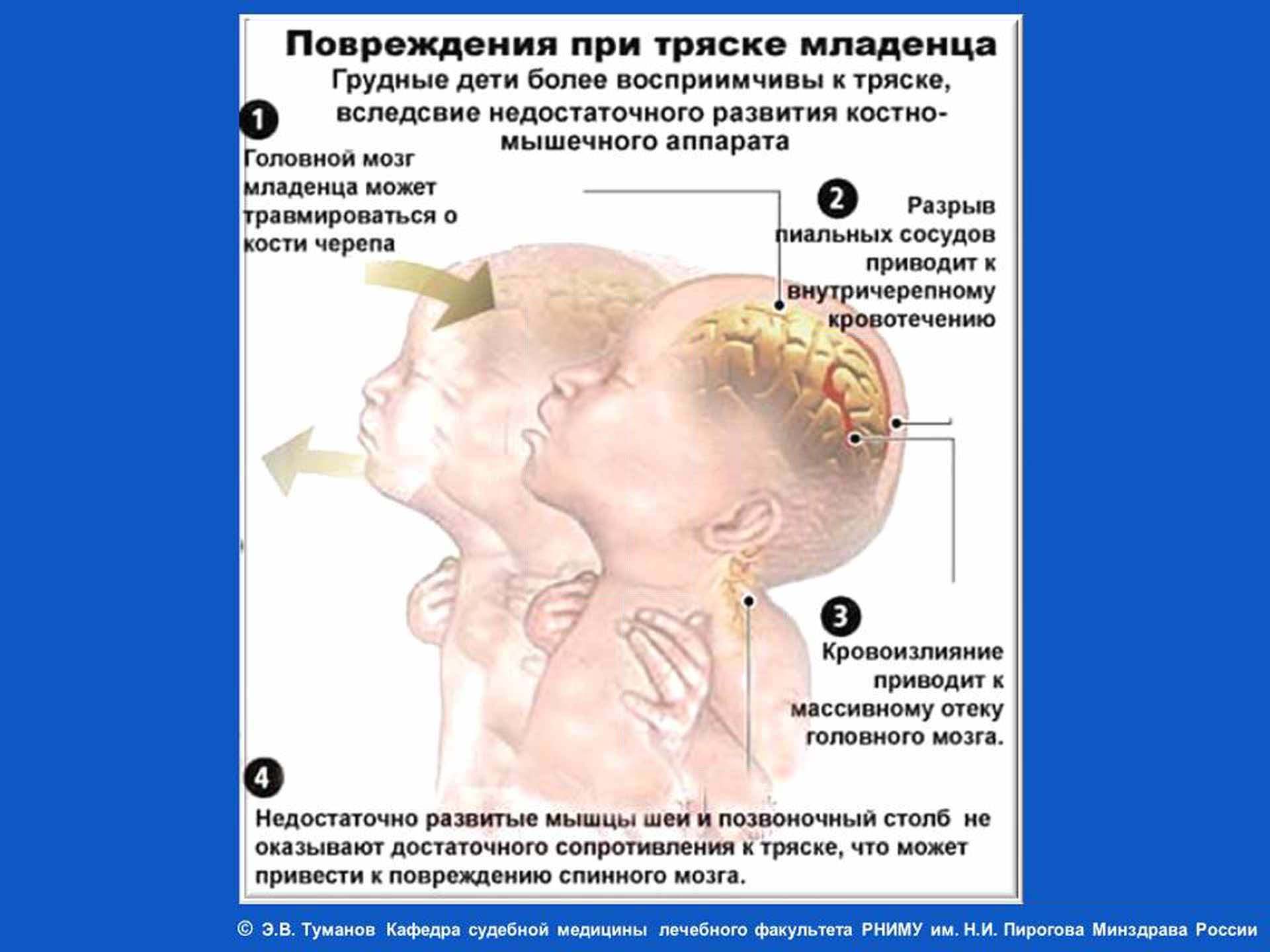 Что такое синдром тряски младенца