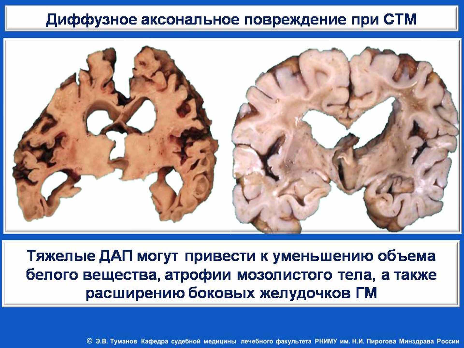 Атрофия головного мозга лечение