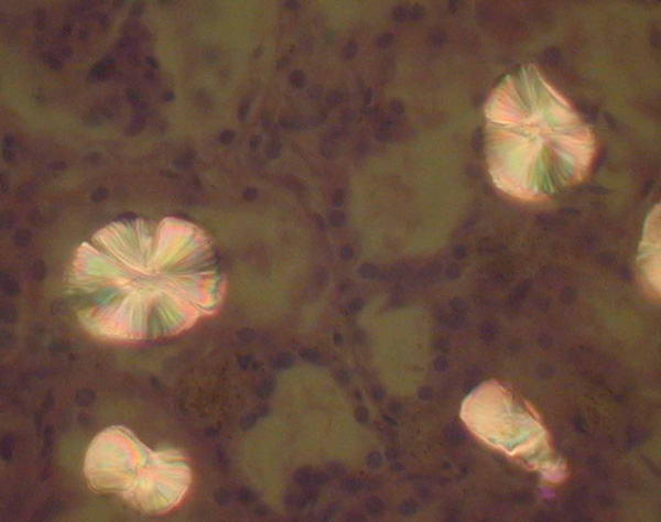 Кристаллы оксалатов кальция при поляризационной микроскопии