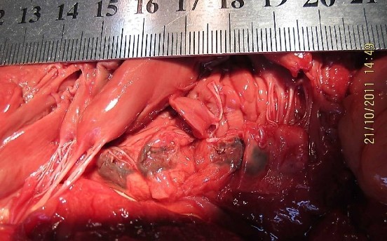 Огибающая ветвь левой венечной артерии с обызвествлением, кровоизлиянием