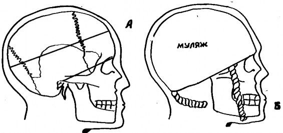 Схема изъятия костей мозгового черепа