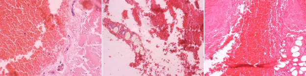 Кровоизлияния, представленные эритроцитами с четкими контурами, среди которых не определяются лейкоциты