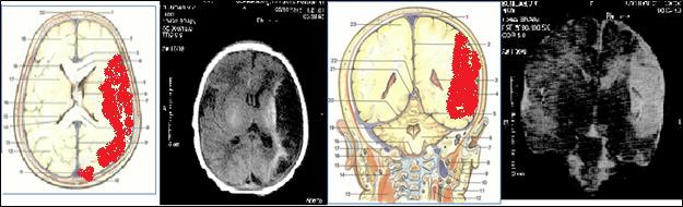 Повреждения головного мозга на МРТ