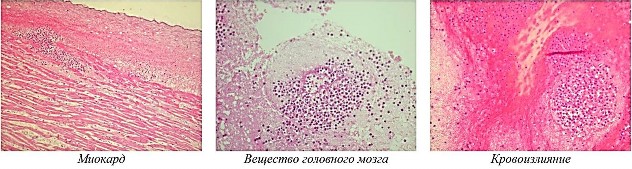 Микроскопическая картина из патологических областей с наличием опухолевых лейкозных инфильтратов
