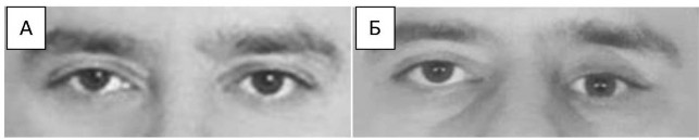Деформации мягких тканей лица в левой глазничной и носовой области, обусловленная переломами нижней стенки левой глазницы