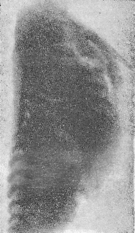 Рентгенограмма трупа в боковой проекции. Эмфизема средостения. На фоне газа хорошо видна вилочковая железа