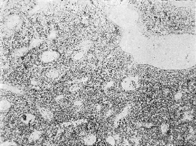 Микрофото ангиоматозной саркомы перителиомообразного строения