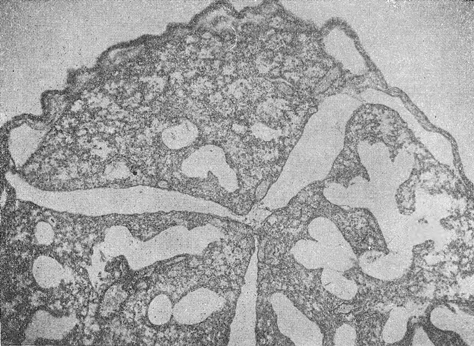 Выраженная интерстициальная эмфизема с прорывом воздуха под плевру. Окраска по ван Гизону. Х26.