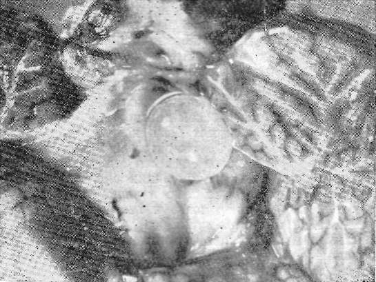 Цистицерк, посмертно переместившийся из устья сильвиева водопровода в центральную часть IV желудочка