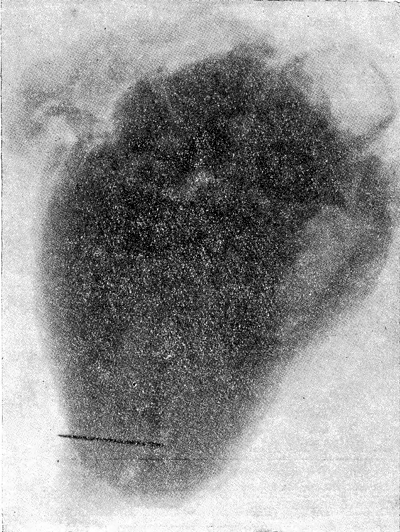 Рентгенограмма сердца гр-на Л. 