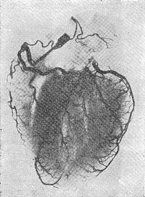 Ангиограмма сердца