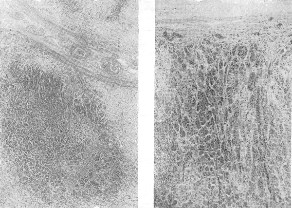 Рис. 5. Широкая пестрая кора с резко сниженной прозрачностью. Увеличение 8×10. Гематоксилин-эозин.