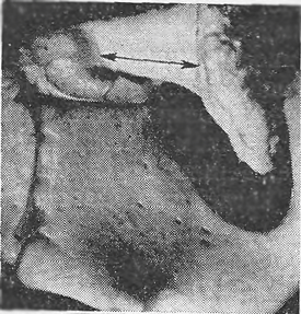 Валикообразные вспучивания на внутренней поверхности горизонтальной ветви лобковой кости
