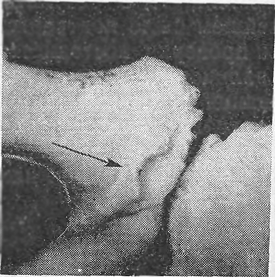 Валикообразное вспучивание на внутренней поверхности тела левой лобковой кости