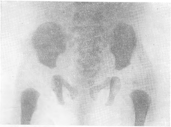 Рентгенограмма таза мальчика 14 лет